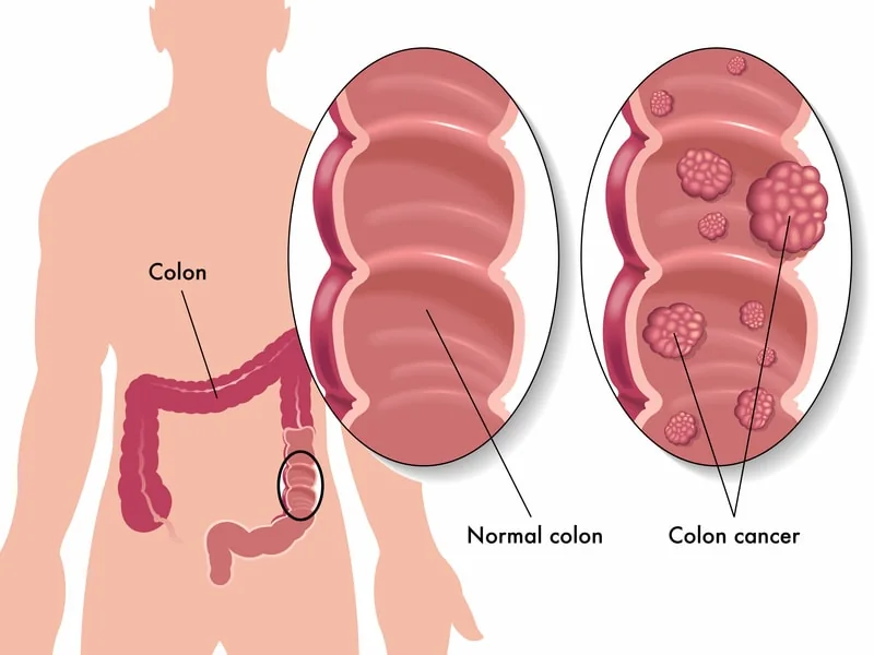 Acudir con el especialista en cáncer de colon es fundamental para evitar la pérdida de su calidad de vida