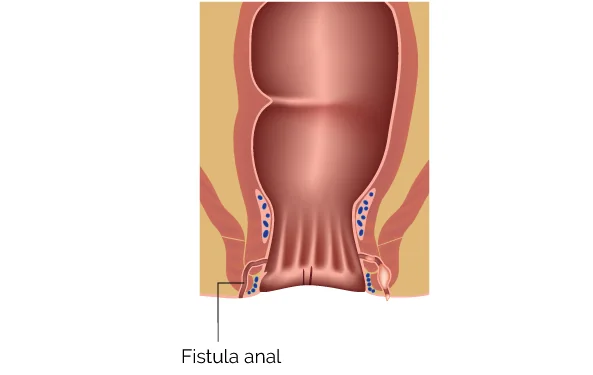Cómo es el procedimiento quirúrgico para el tratamiento de fístulas anales