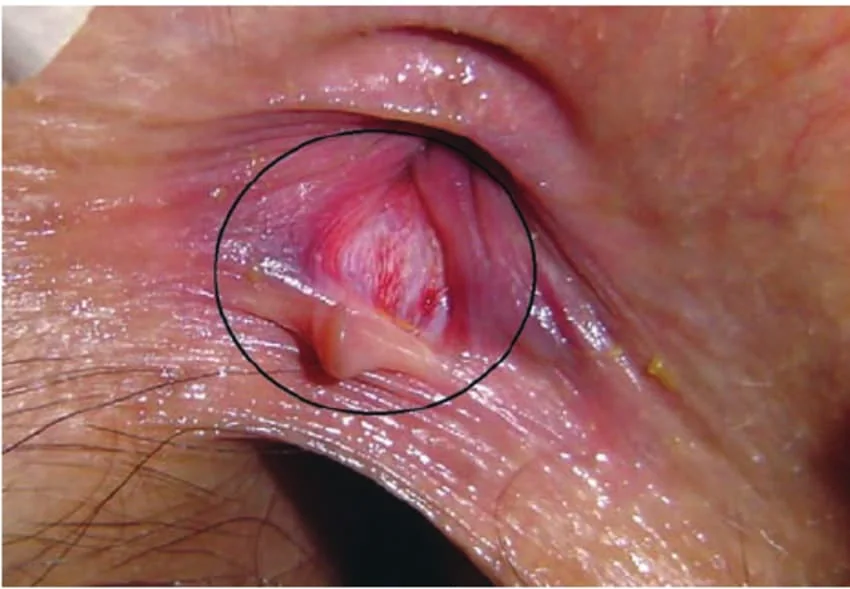 Fisura anal tratamiento cómo evitarlas y por qué no hay que vivir con este dolor