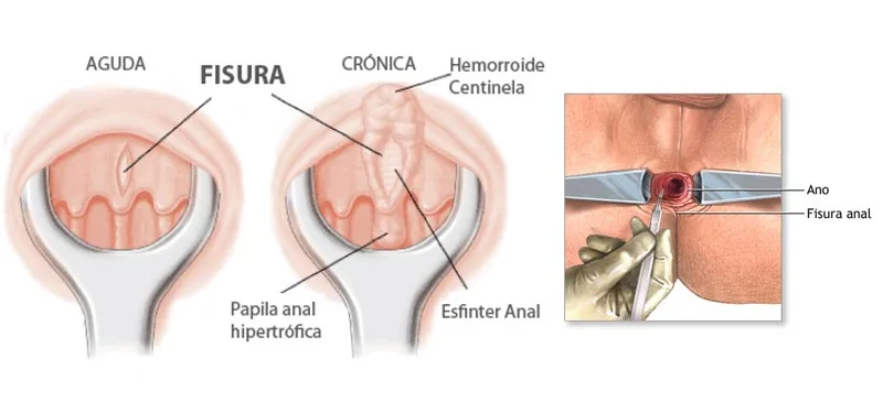 Fisura anal tratamiento | Tipos de fisuras anales