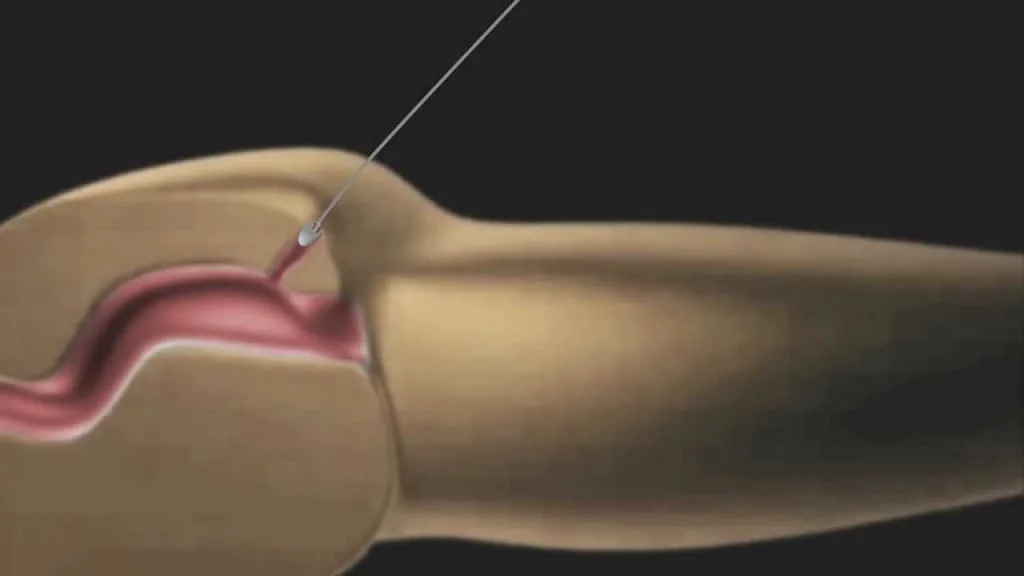 Lo que querías saber sobre la fisura anal tratamiento
