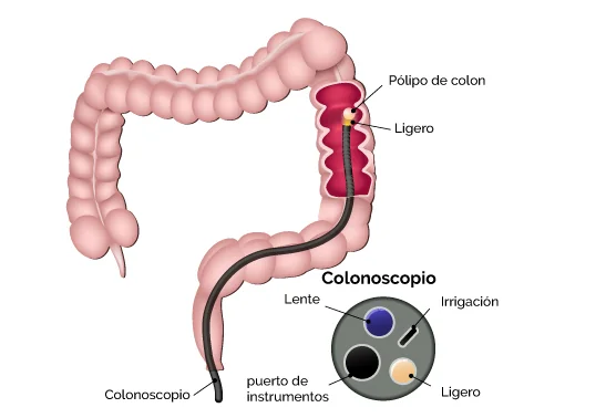 Ilustración de videocolonoscopía