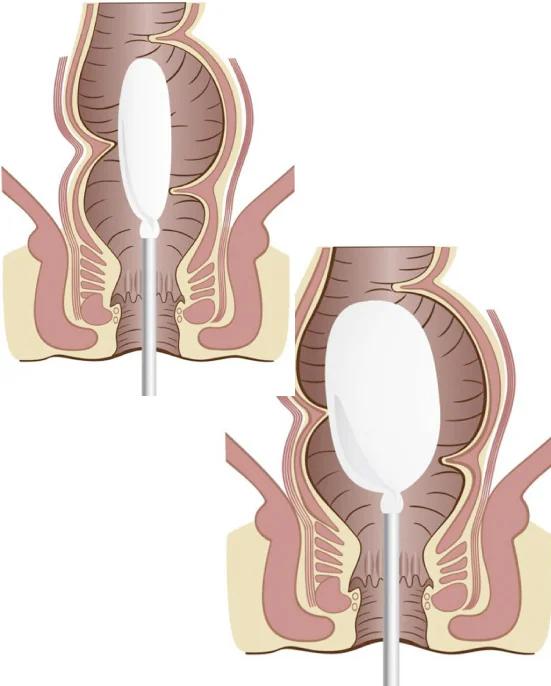 Ilustración de estudio anorrectal
