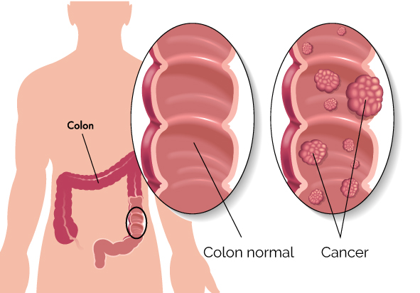 cancer-de-colon-y-recto